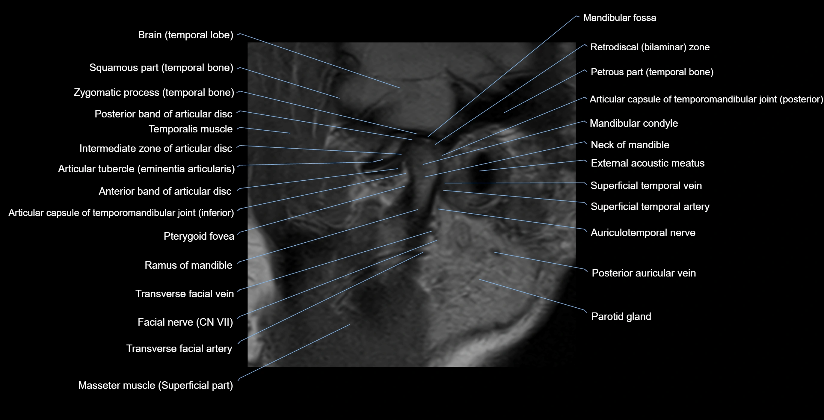 MRI TMJ sagittalclosed  mouth cross sectional 3T anatomy -img-00001-00006.webp